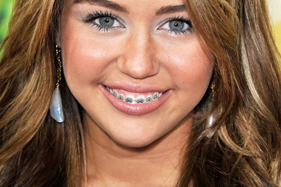 Celebrities that Have Had Braces