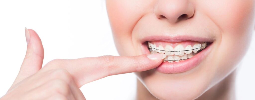Most Common Precursors to Braces