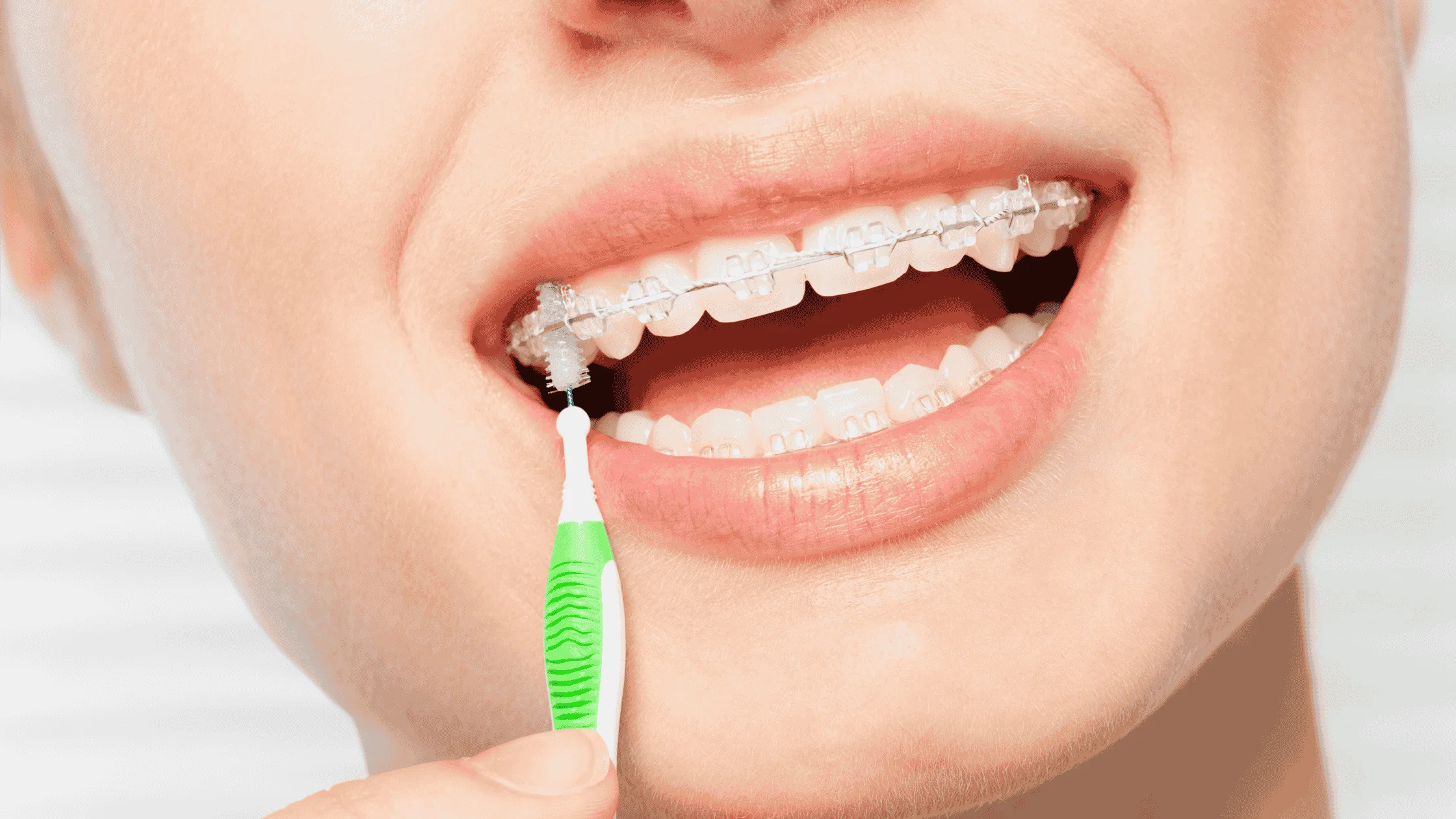 Clear-Braces-Care
