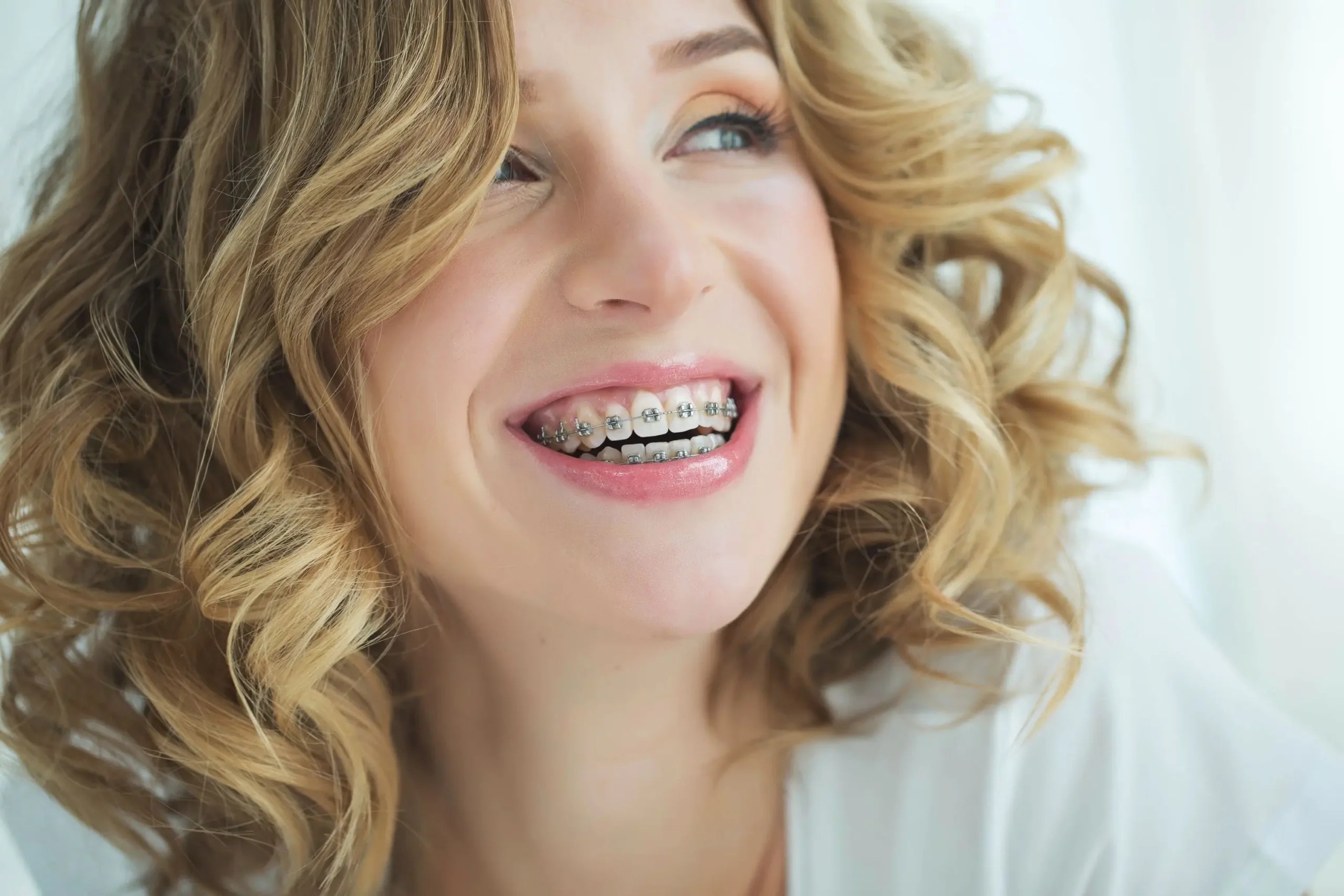 Damon Braces