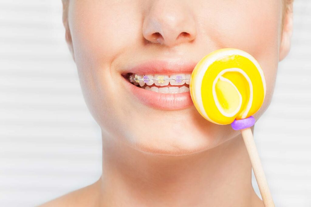 Candy to Always Avoid When You Have Traditional Braces