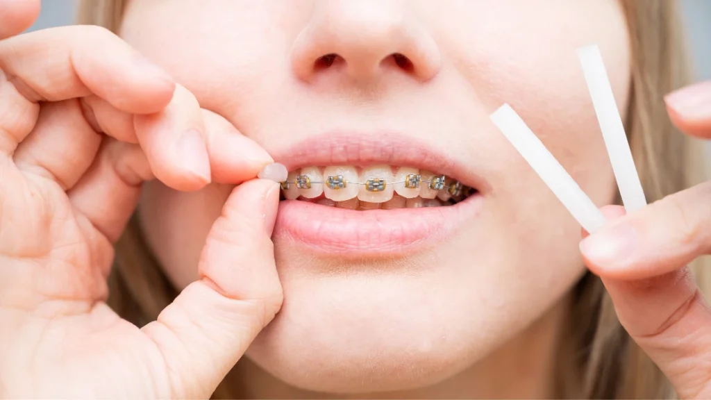 Dental Wax So Imperative to Have Around When You Have Braces
