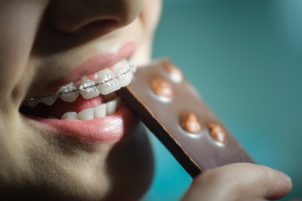 Is Any Food Off-Limits with Ceramic Braces?