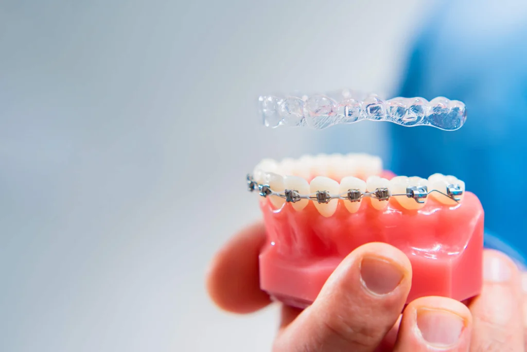 Metal Braces vs. Aligner Trays