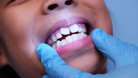 Mild Cleft Palates