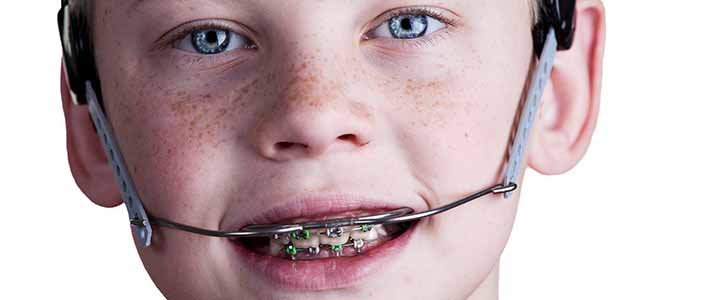 Orthodontics-headgear