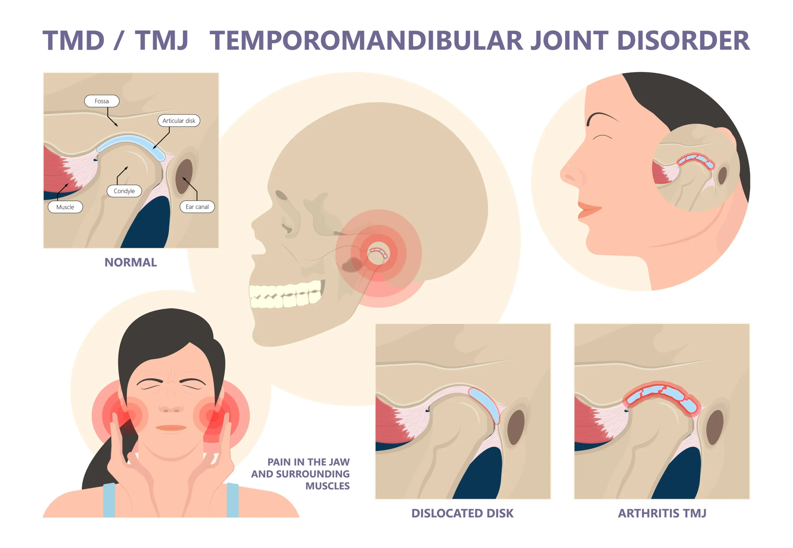 TMJ disorder