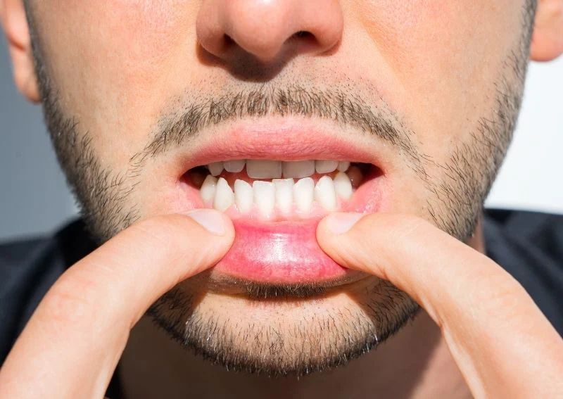 Underbite-Can-You-Fix-It-Without-Underbite-Surgery