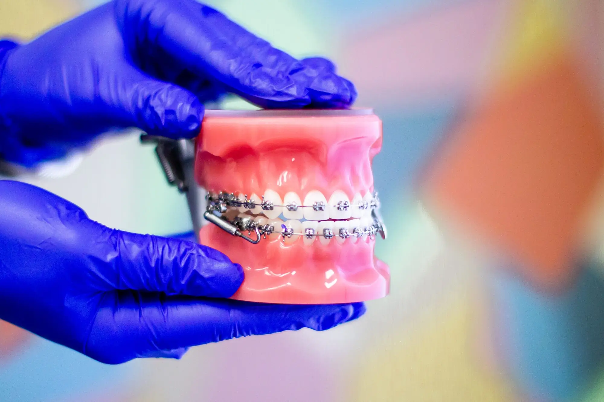 What Are Forsus Springs and How Do They Affect Your Teeth? - Sawrie ...
