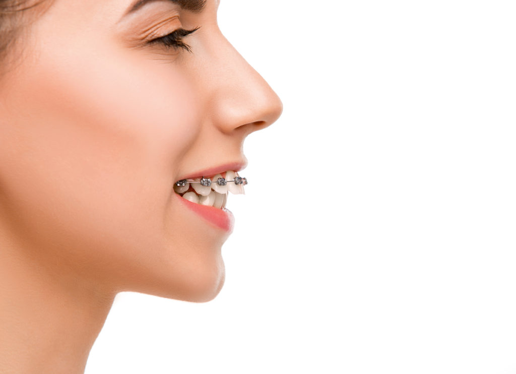 Beautiful young woman with teeth braces on gray