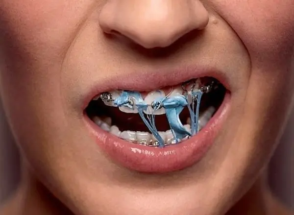 candy stuck in braces candy stuck in braces