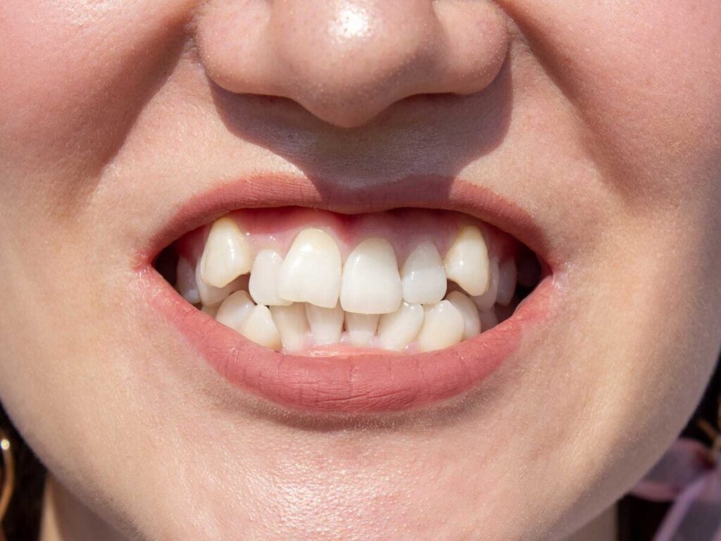 curved-female-teeth-before-installing-braces-close-up-teeth-before-treatment-by-orthodontist