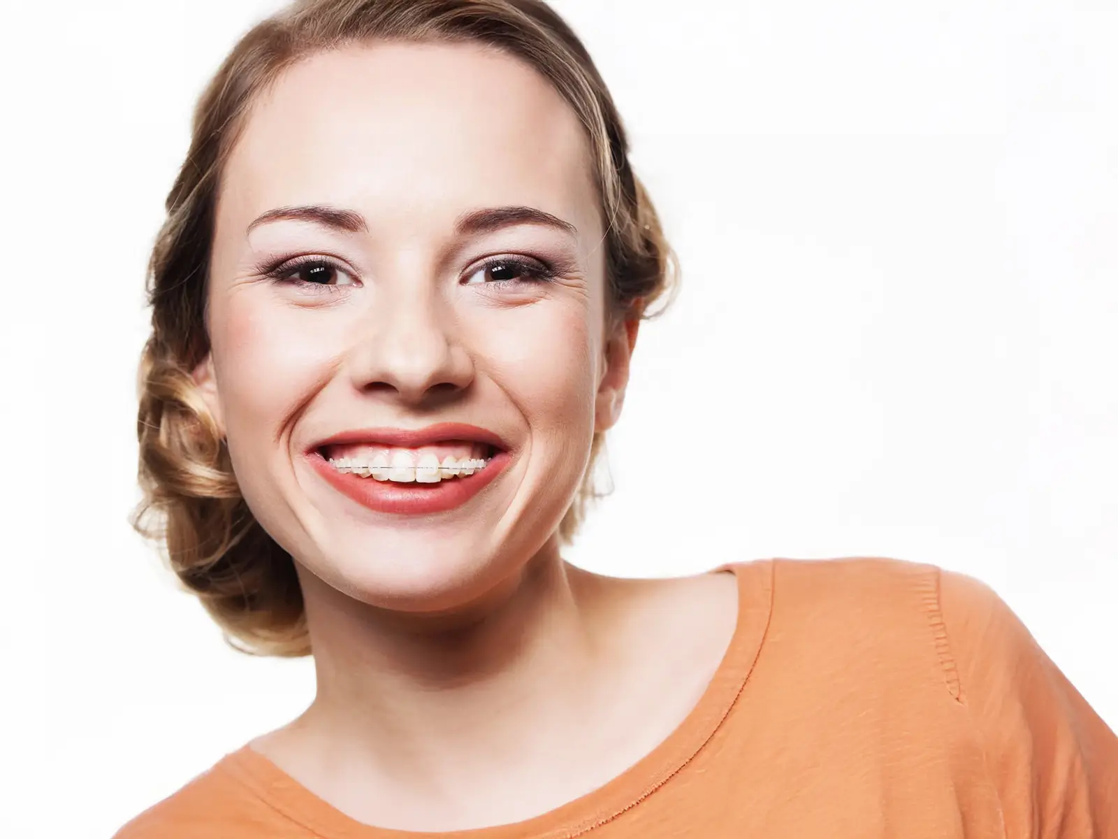 Damon Clear Braces