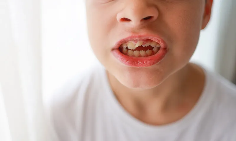 open-bite