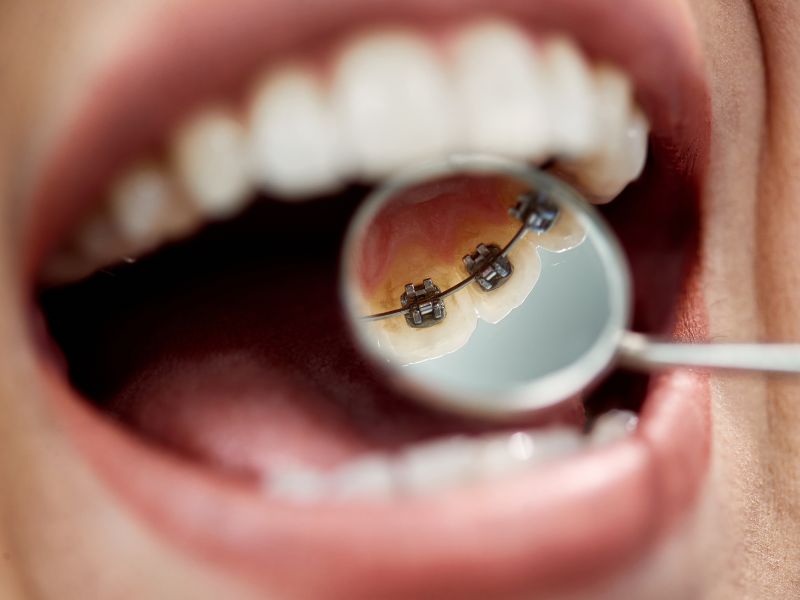 Incognito (Lingual) Braces