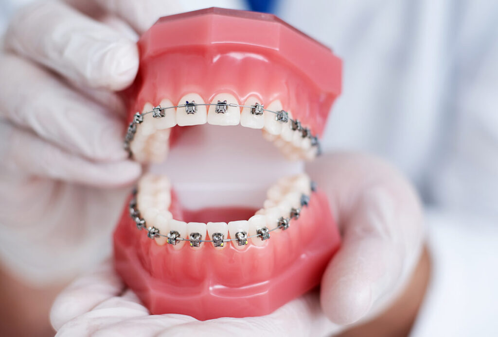 traditional-metal-braces