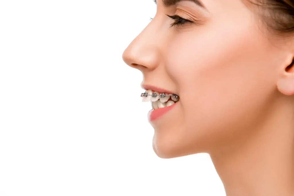 what-is-an-overbite